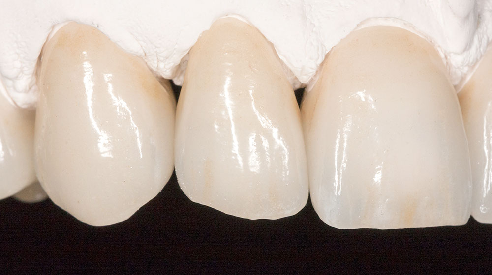 e.max(イーマックス)クラウン