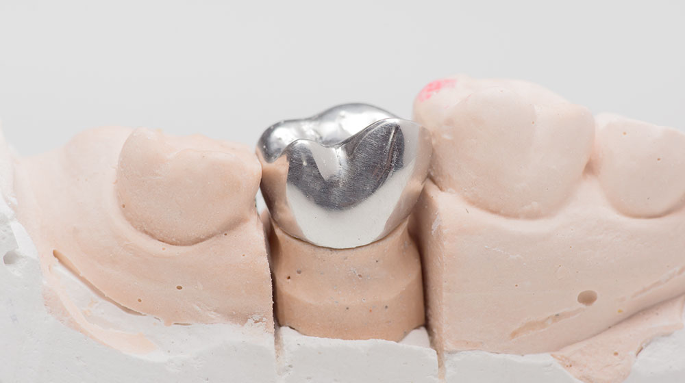 銀歯クラウン(保険適応)