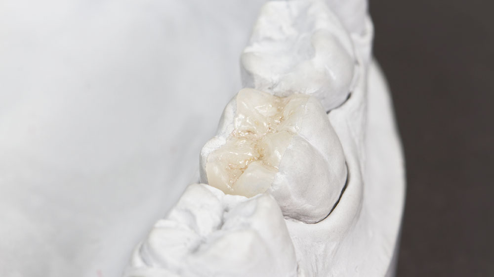 e.max(イーマックス)インレー