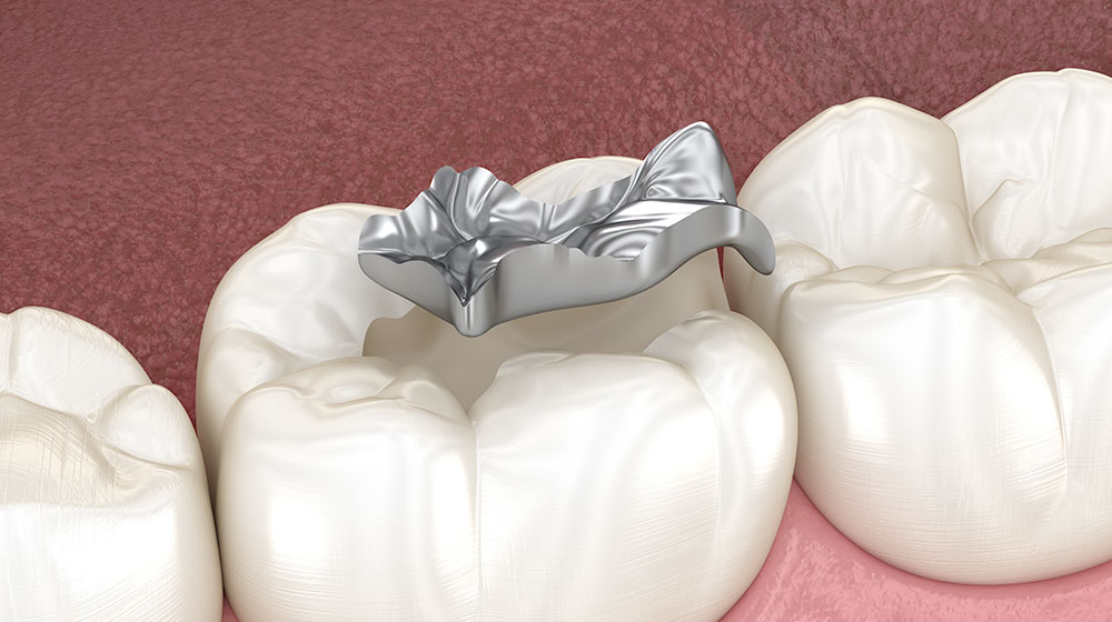 銀歯インレー(保険適応)