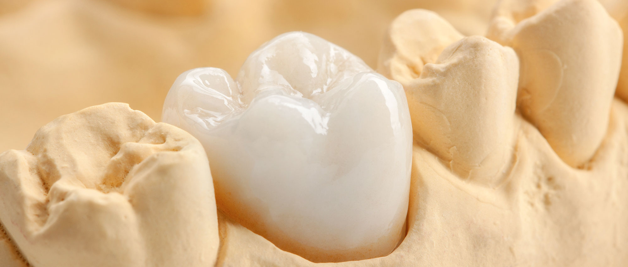 セラミック治療