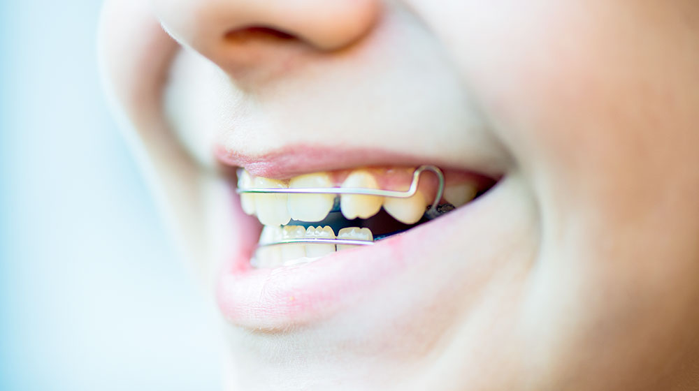 顎の成長をコントロールできる