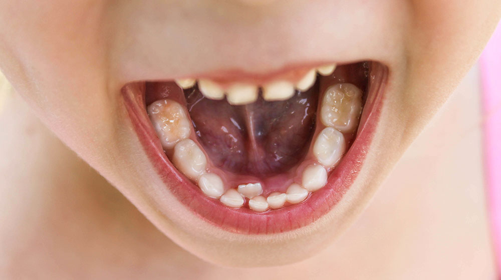 永久歯が正しい位置に生える