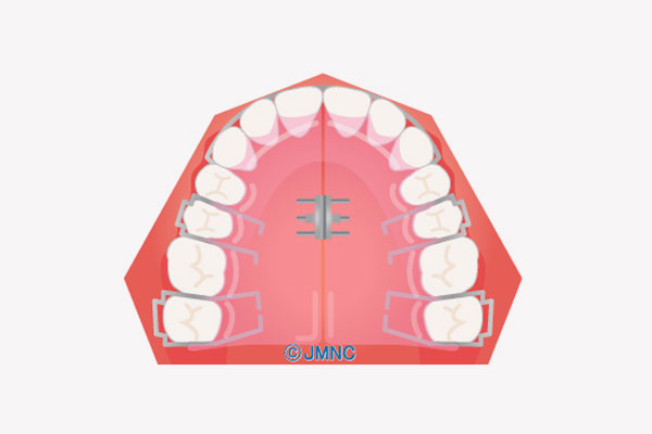 出っ歯(上顎前突)
