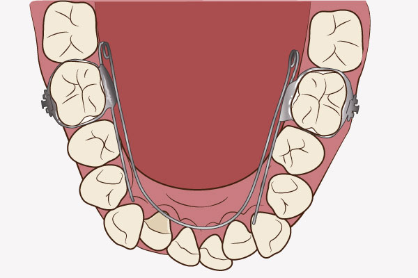 歯列矯正用ワイヤ