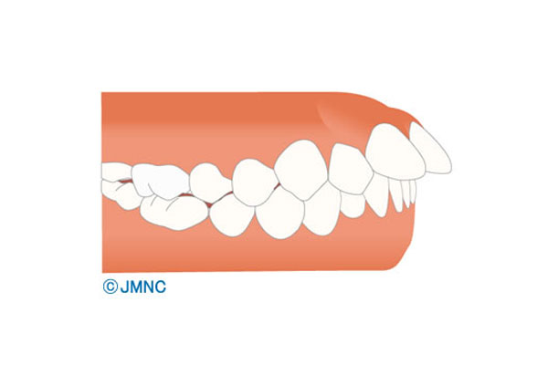 出っ歯(上顎前突)