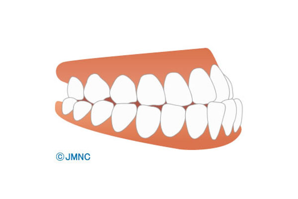 受け口(反対咬合、下顎前突)