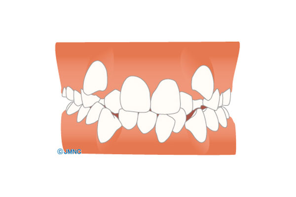 デコボコ・八重歯(叢生)