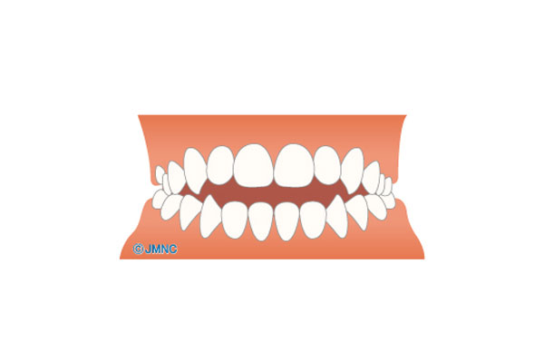 上と下の前歯が噛み合わない(開咬)