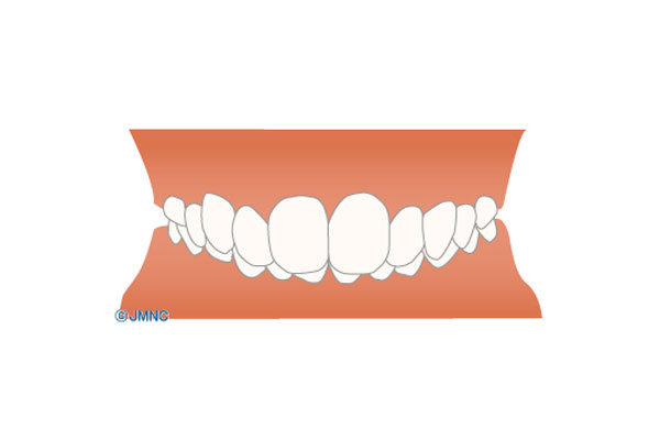 噛み合わせが深い(過蓋咬合)