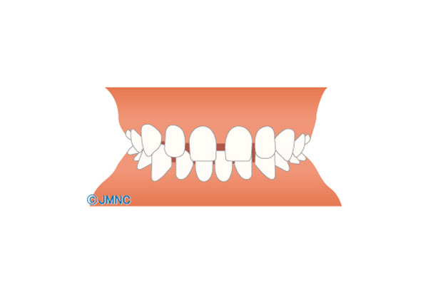 すきっ歯(空隙歯列)