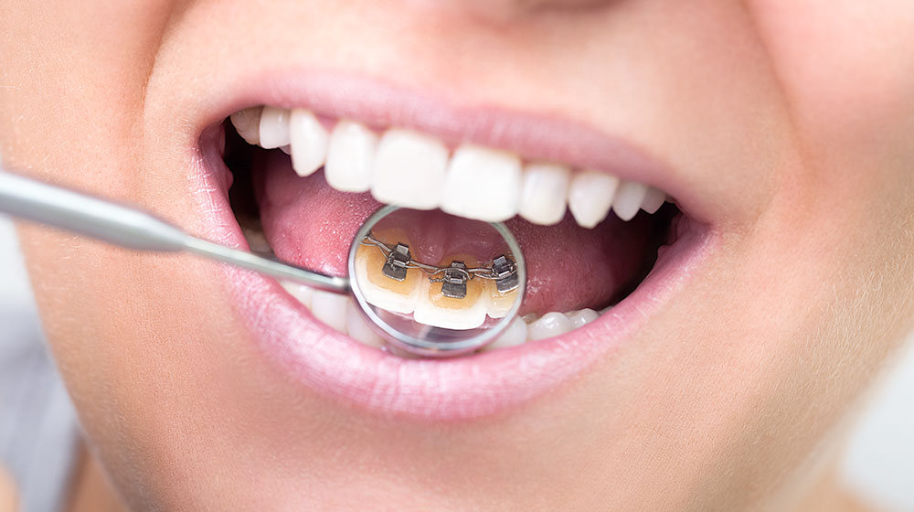 治療中の見た目がよい