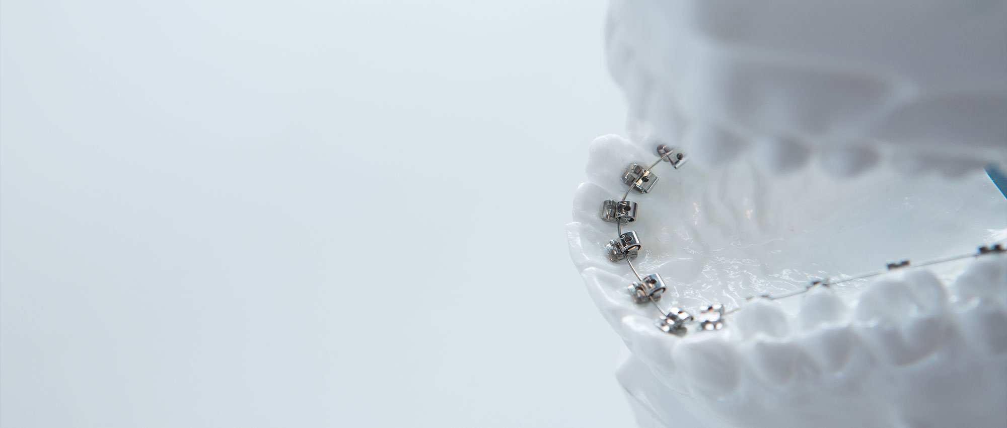 見えにくい舌側矯正