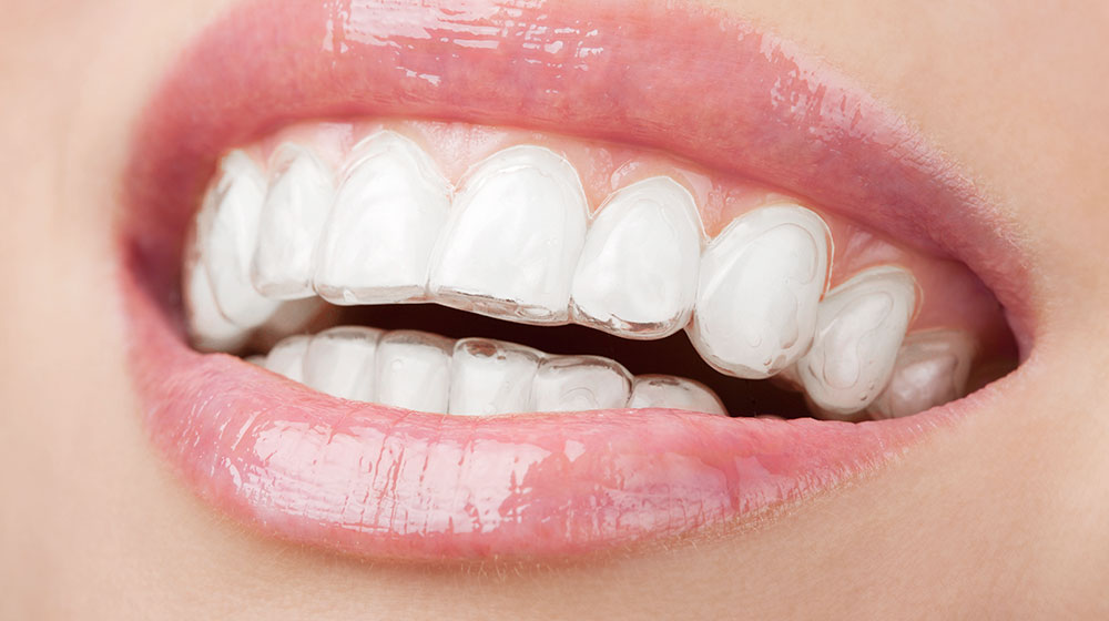 装置を付けていても目立ちにくい