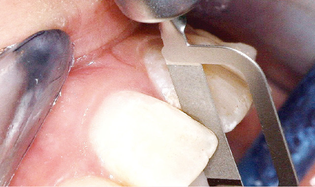 4.矯正前治療・準備